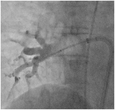 Cryoballoon Ablation of Atrial Fibrillation Without Demonstration of Pulmonary Vein Occlusion—The Simplify Cryo Study